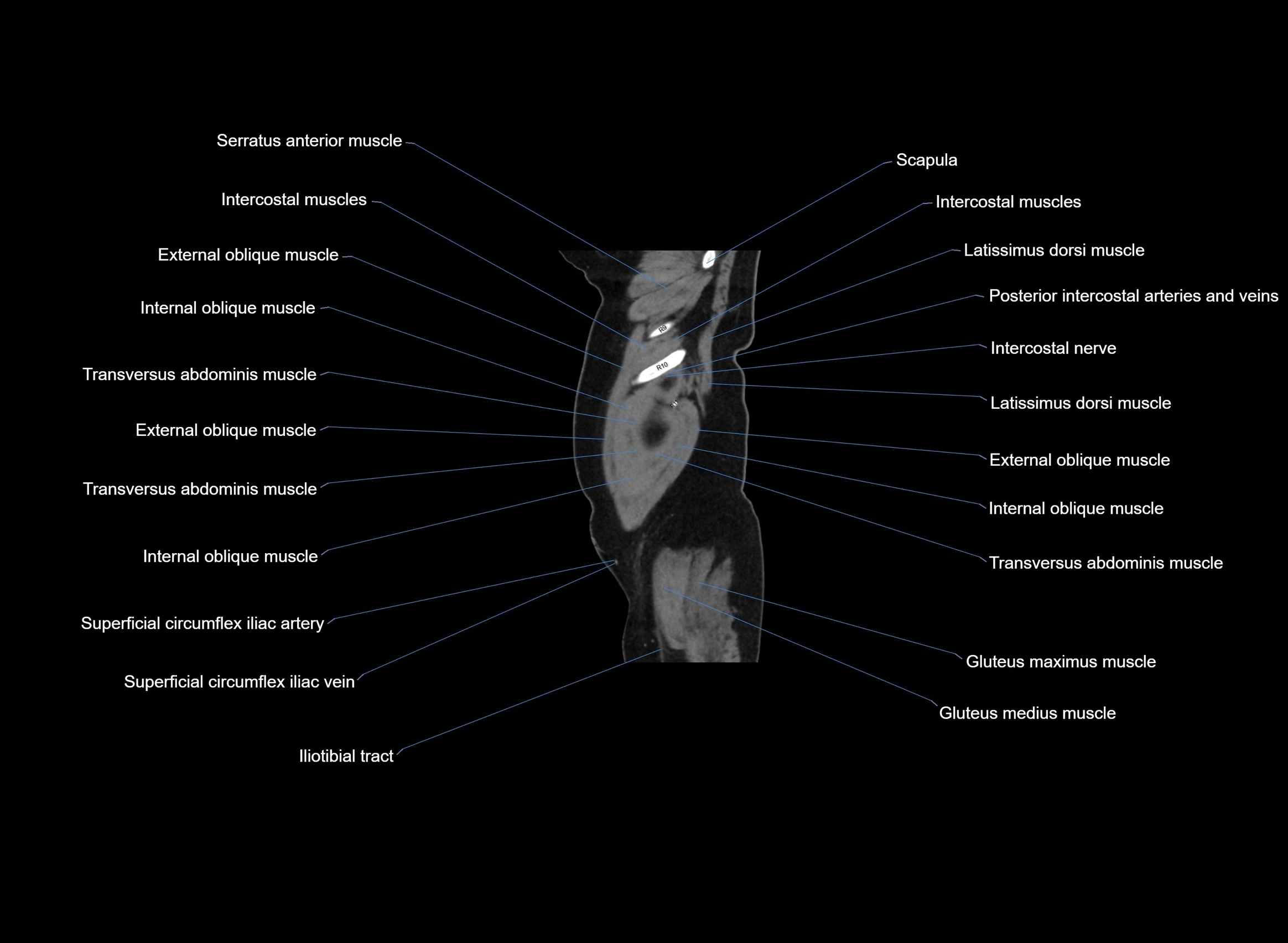 CT Abdomen sagittal cross sectional anatomy labelled radiology image -00105.webp